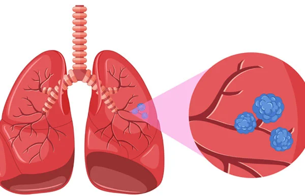 Lung Cancer
