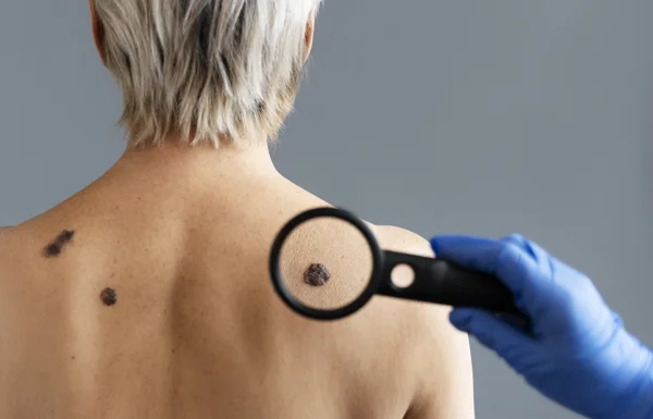 Melanoma