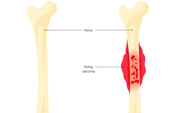 Sarcomas Of Bone And Soft Tissue