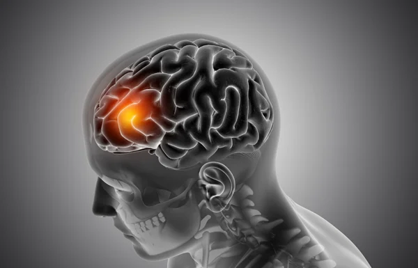 Brain Tumors